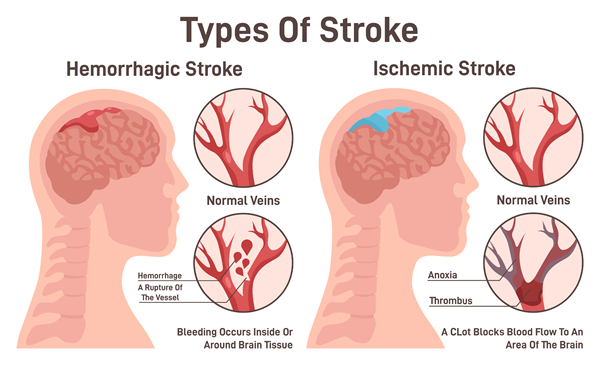stroke