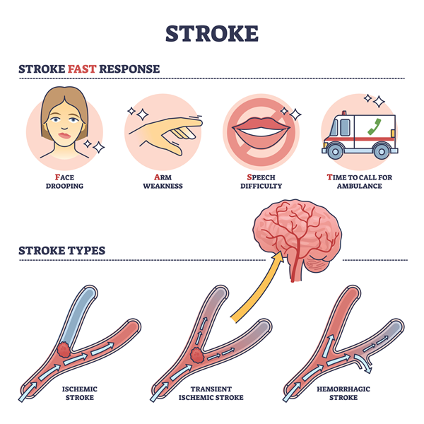stroke